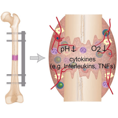 The inflammatory response in bone